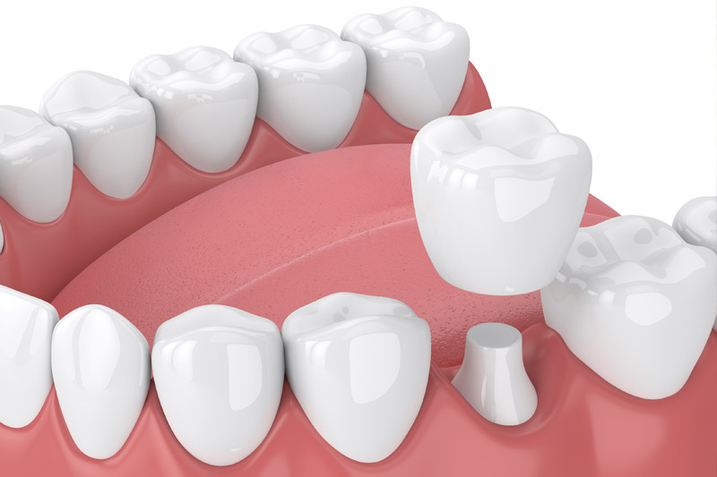 Dental Crowns in Mt Pleasant