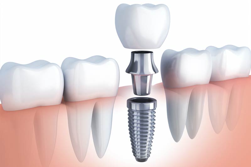 Implants Dentist in Mt Pleasant