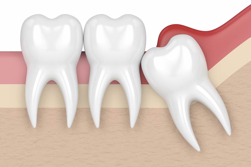 Wisdom Tooth Removal in Mt Pleasant